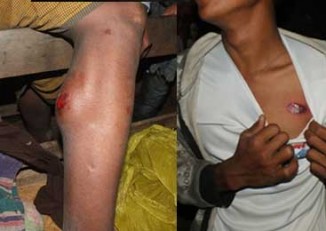 Two protestors from Mogyopyin show their wounds which they say were caused by rubber bullets fired by police as they attempted to join a protest camp near the Latpadaung copper mine site in Monywa, Sagaing division, on Friday, 15 November 2013. (PHOTO: DVB)